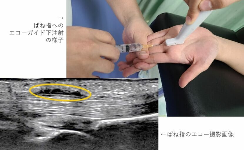 エコーガイド下注射で筋膜をリリース 山室クリニック 富山市の整形外科 交通事故治療 内科
