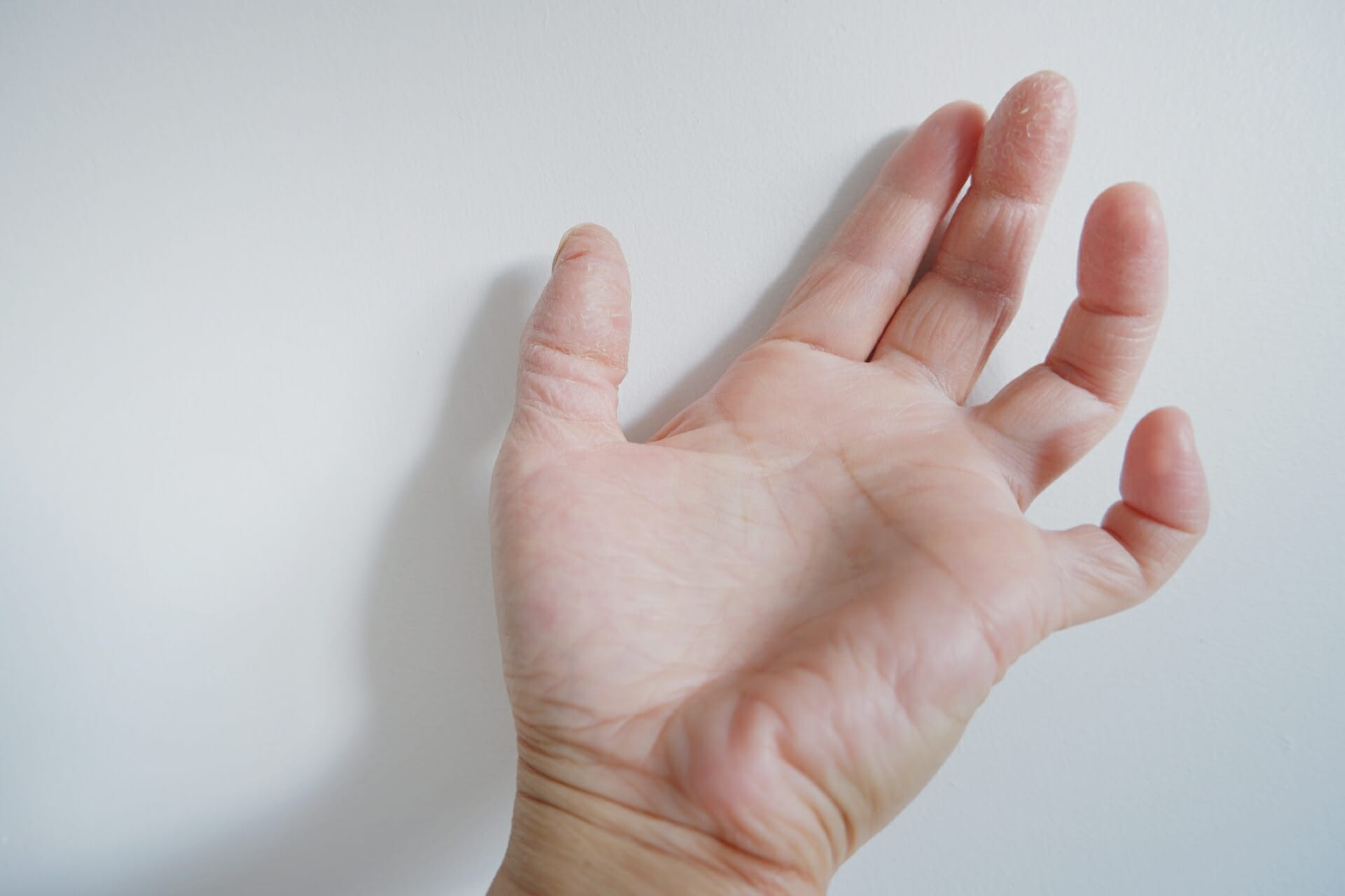 ばね指(弾発指)は自力で治せる？原因と療法の解説 | 山室クリニック